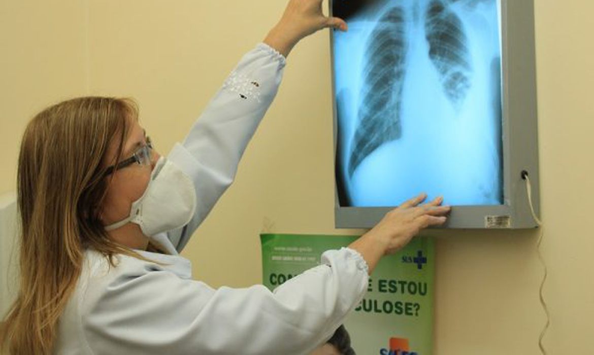 RJ, Acre e Amazonas lideram ranking de mortes por tuberculose no país