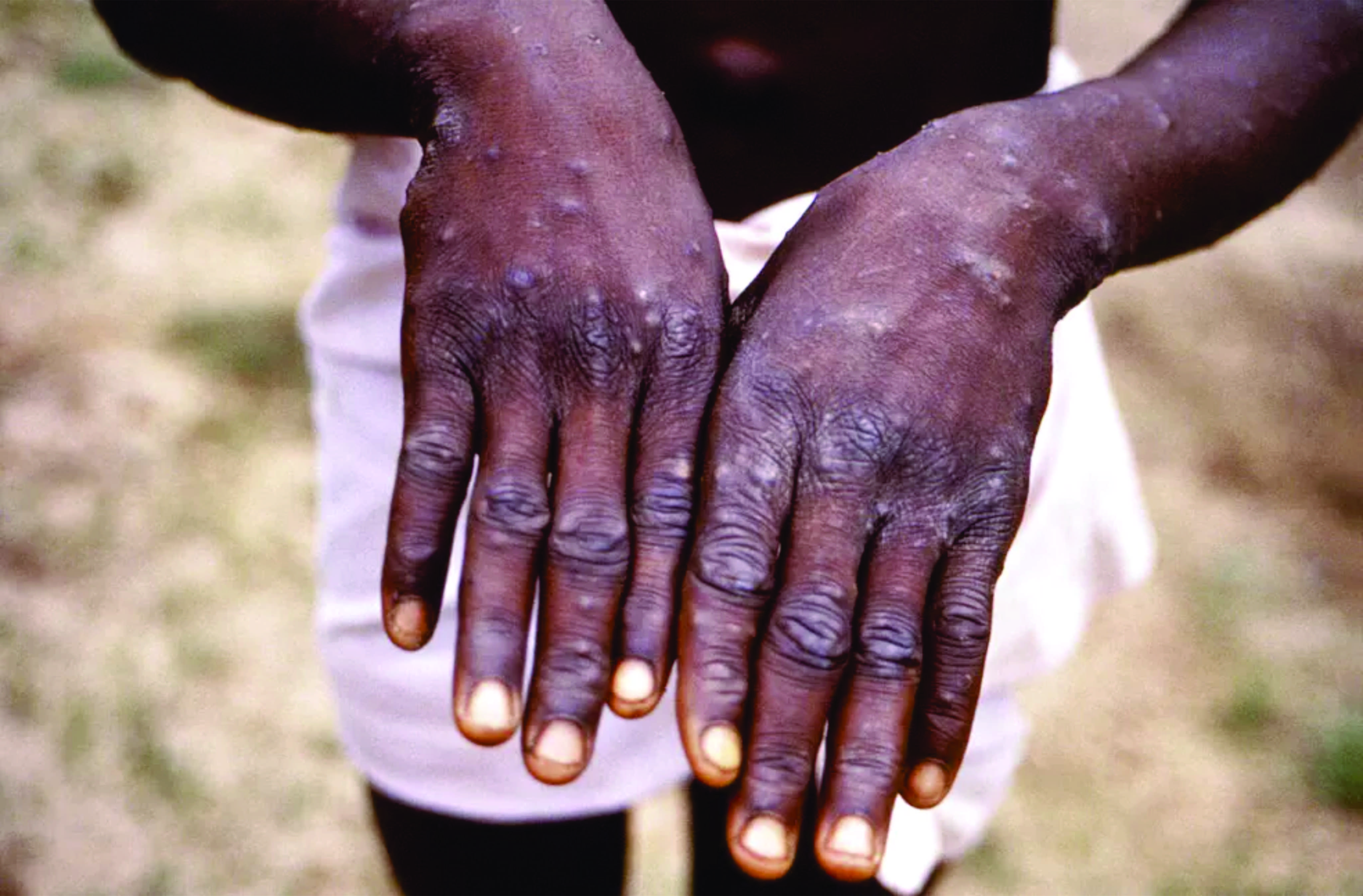 Varíola dos macacos: como saber se irritação na pele pode ser a doença?