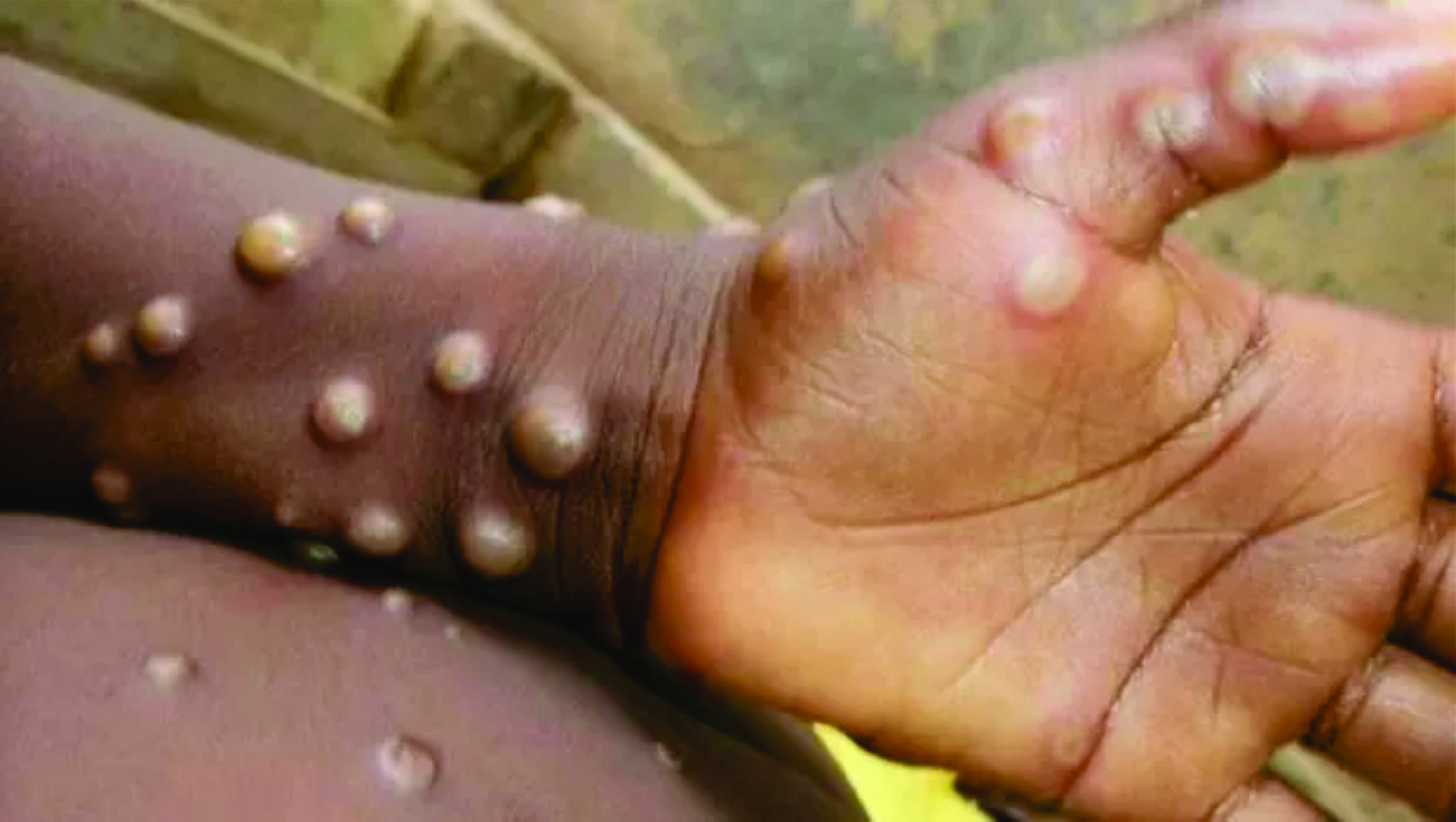 Mundo registra 780 casos de varíola dos macacos fora da África